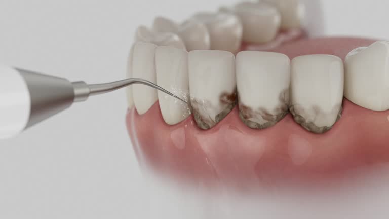 Trusted Dental Crowns And Bridges service in Willards, MD - Dentist Open Now